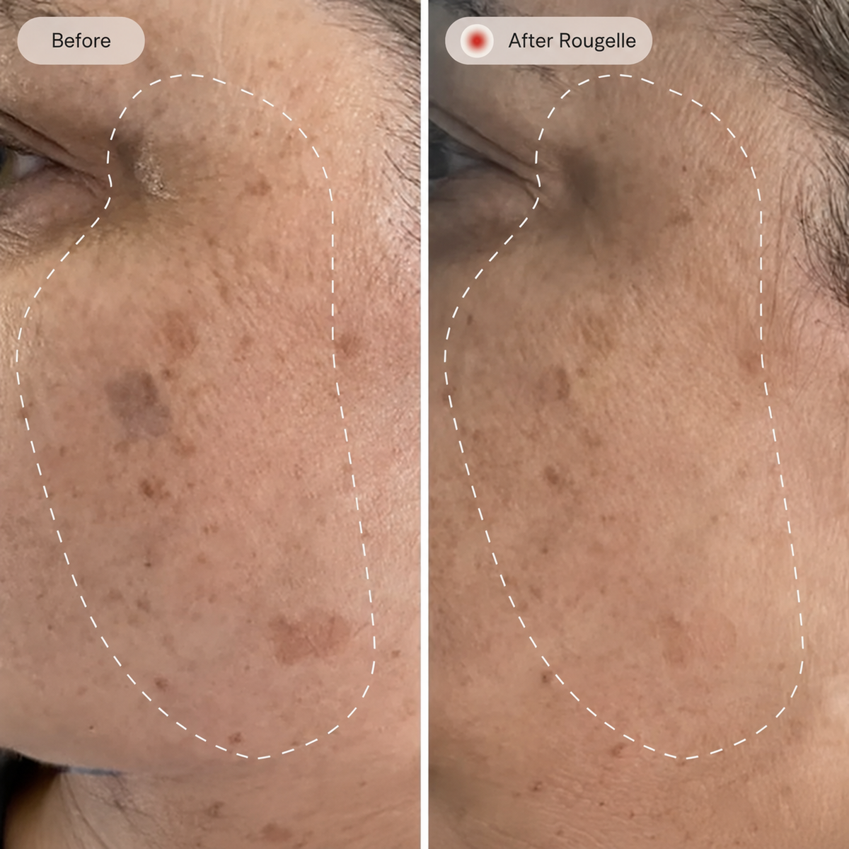 Before and after Rougelle — comparison 1