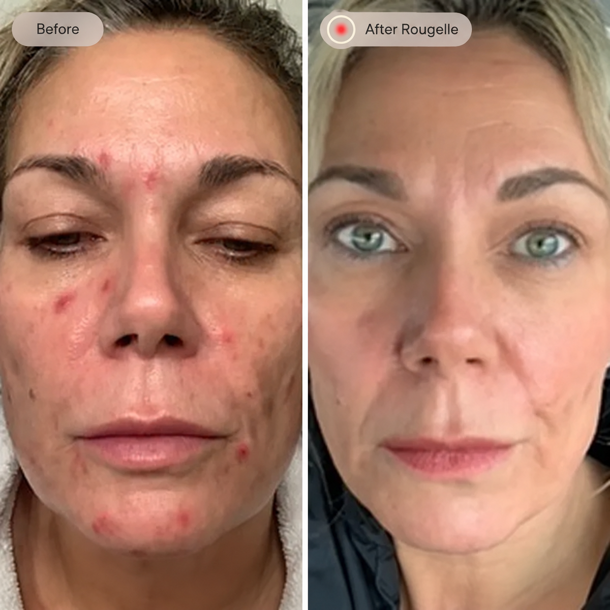 Before and after Rougelle — comparison 2