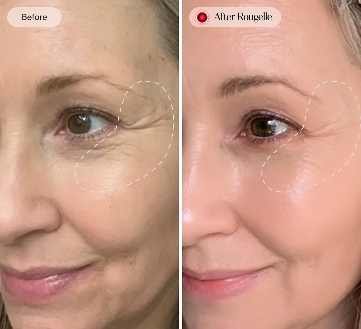 Before and after Rougelle — comparison 3