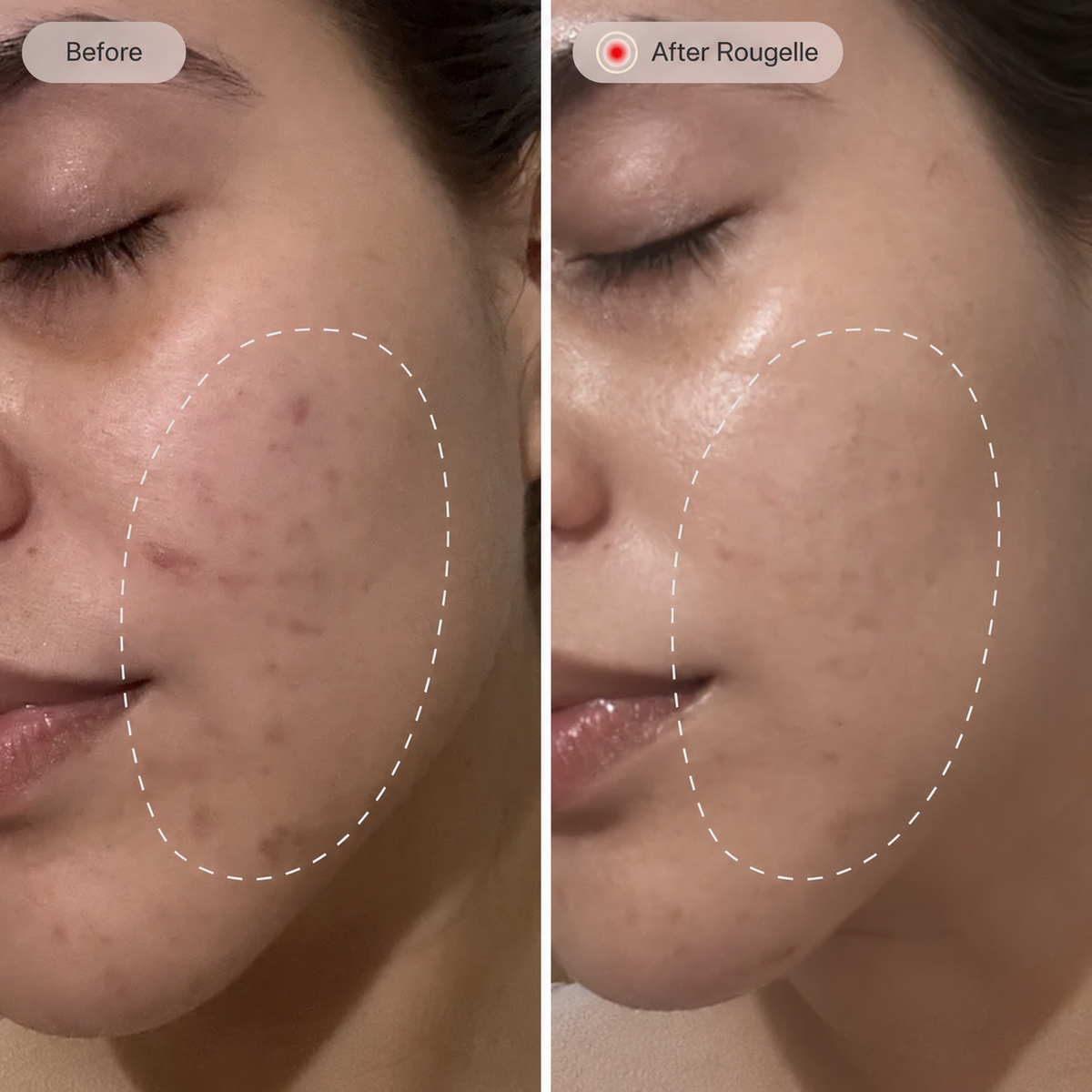 Before and after Rougelle — comparison 4